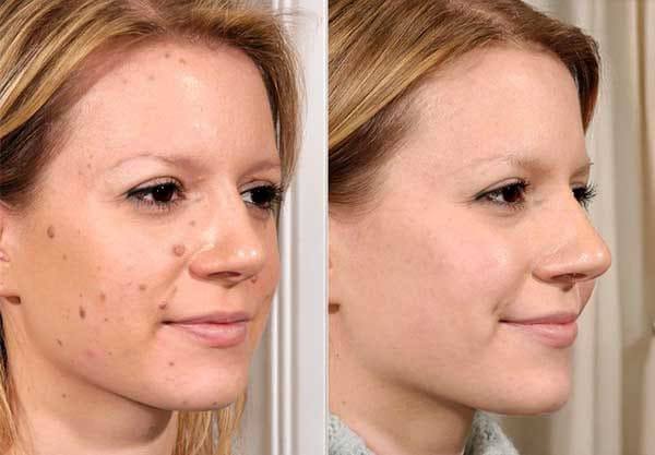 Prije i poslije - bradavice na licu